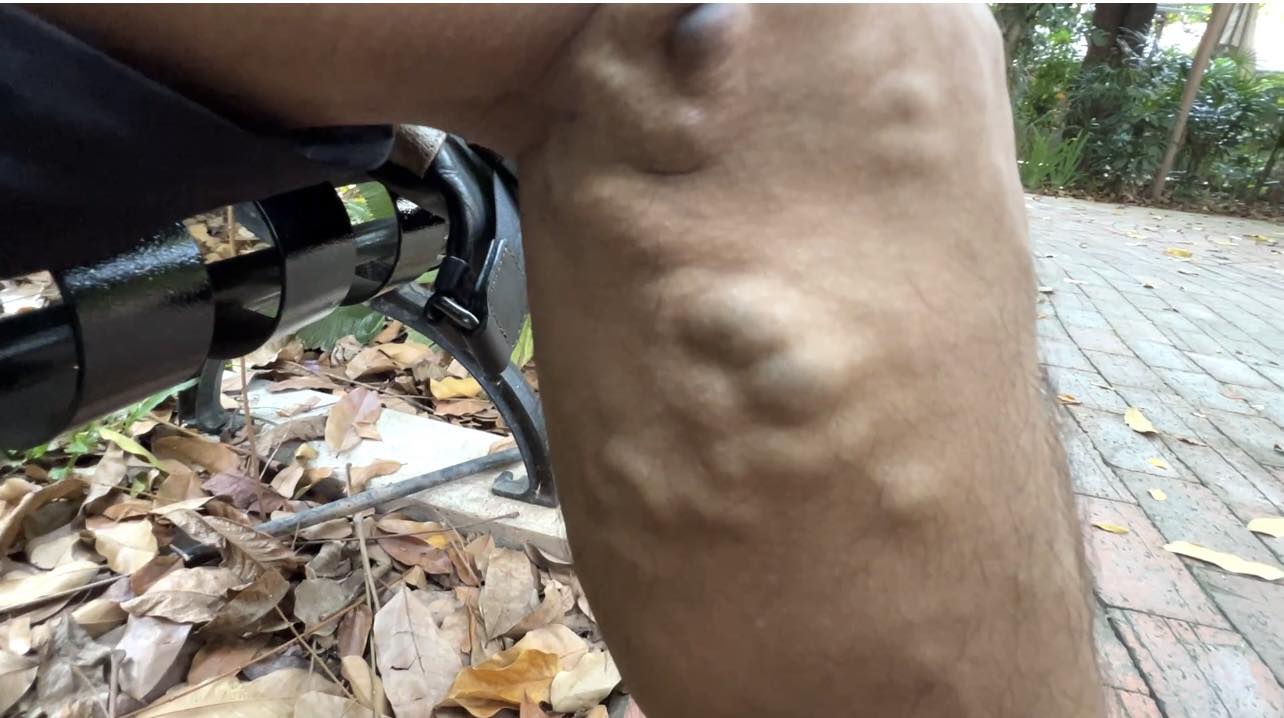 ការព្យាបាល